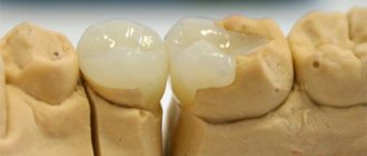 Ceramic inlay