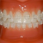Ceramic braces on teeth...