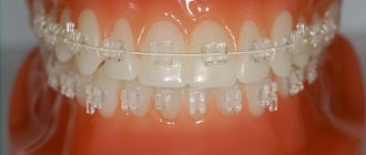 Ceramic braces on teeth...