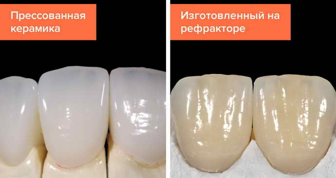 Керамические лучше напоминают натуральный вид зубов