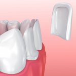 Ceramic veneers