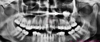 maxillary sinus cyst