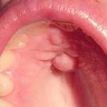 Киста на небе