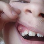 Tooth cyst in a child