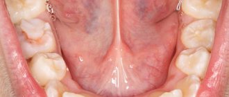 Clinic of sialadenitis of the submandibular salivary gland photo