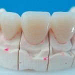 Когда ортодонт рекомендует исправить прикус коронками