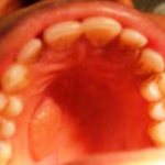 Коллагенозная фиброма твёрдого нёба: описание редкого клинического случая