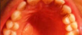 Collagenous fibroma of the hard palate: description of a rare clinical case