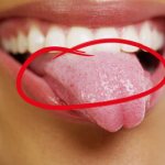 condylomas on the tongue
