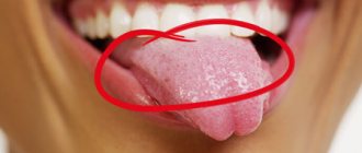 condylomas on the tongue