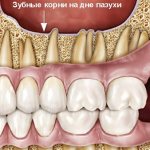 Корни зубов у дна верхнечелюстной пазухи