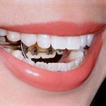 коррекция лингвальными брекетами