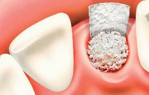 Костный материал в стоматологии применение