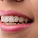 Кривые зубы у девушки. Фото до и после, как исправить, методы с брекетами и без