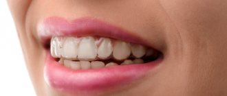 Кривые зубы у девушки. Фото до и после, как исправить, методы с брекетами и без