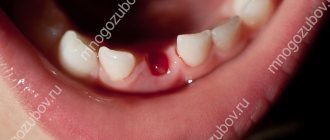 Кровяной сгусток после удаления зуба