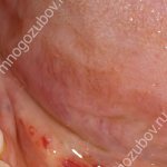 Кровяной сгусток после удаления зуба