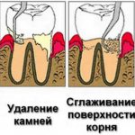 curettage of periodontal pocket
