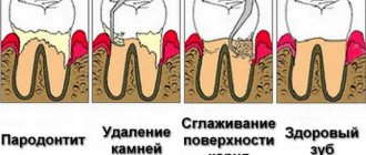кюретаж пародонтального кармана
