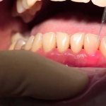 лечение десен лазером