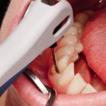 Лечение пародонтита аппаратом Вектор