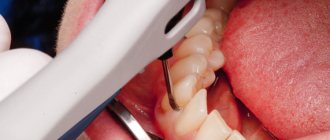 Treatment of periodontitis with the Vector device