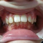 лечение прикуса