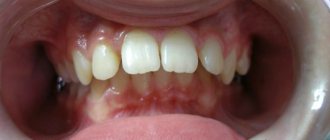 bite treatment