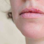 лечение простуды на губах у ребенка 1 год