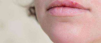 лечение простуды на губах у ребенка 1 год