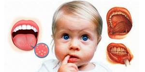 лечение стоматита у детей