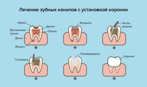 Лечение зубных каналов с установкой коронки в картинках