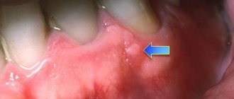 lipoma on the gum