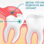 Локализация ретинированных зубов
