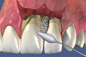 Лоскутные операции в стоматологии