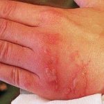 Мазь предупреждает развитие раневой инфекции на местах повреждений и ожогов, способствует регенерации тканей на поверхности кожи