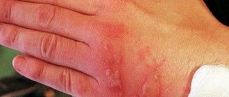Мазь предупреждает развитие раневой инфекции на местах повреждений и ожогов, способствует регенерации тканей на поверхности кожи