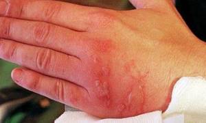 Мазь предупреждает развитие раневой инфекции на местах повреждений и ожогов, способствует регенерации тканей на поверхности кожи