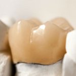 Металлокерамические коронки