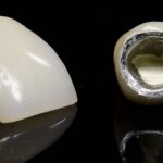 Metal-ceramic crowns