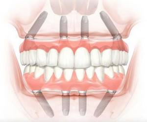 Метод комплексного восстановления зубов All-on-4