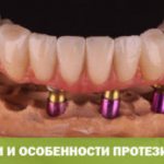 Методики и особенности протезирования