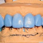Методики воскового моделирования зубов