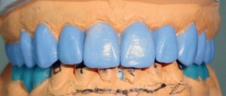 Teeth wax modeling techniques