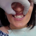 Методы лечения скученности зубов