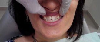 Methods for treating crowded teeth