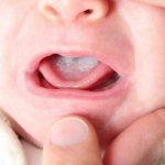 Молочница во рту у ребенка
