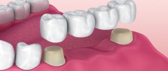 Bridge for teeth