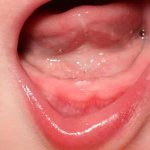 может ли быть сыпь при прорезывании зубов у ребенка