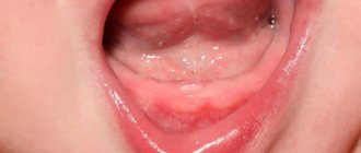 может ли быть сыпь при прорезывании зубов у ребенка